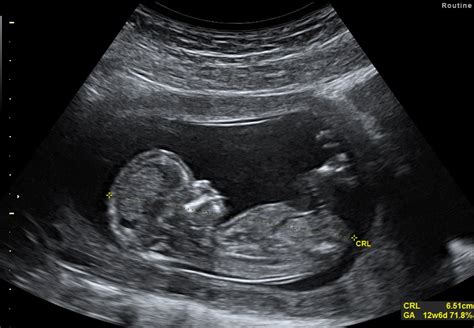 Early pregnancy scan canterbury  This includes children